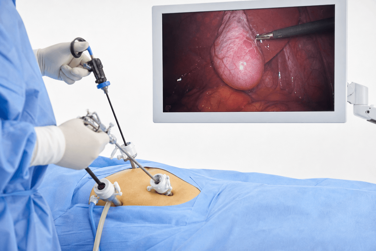 Laparoscopic Gallbladder Surgery