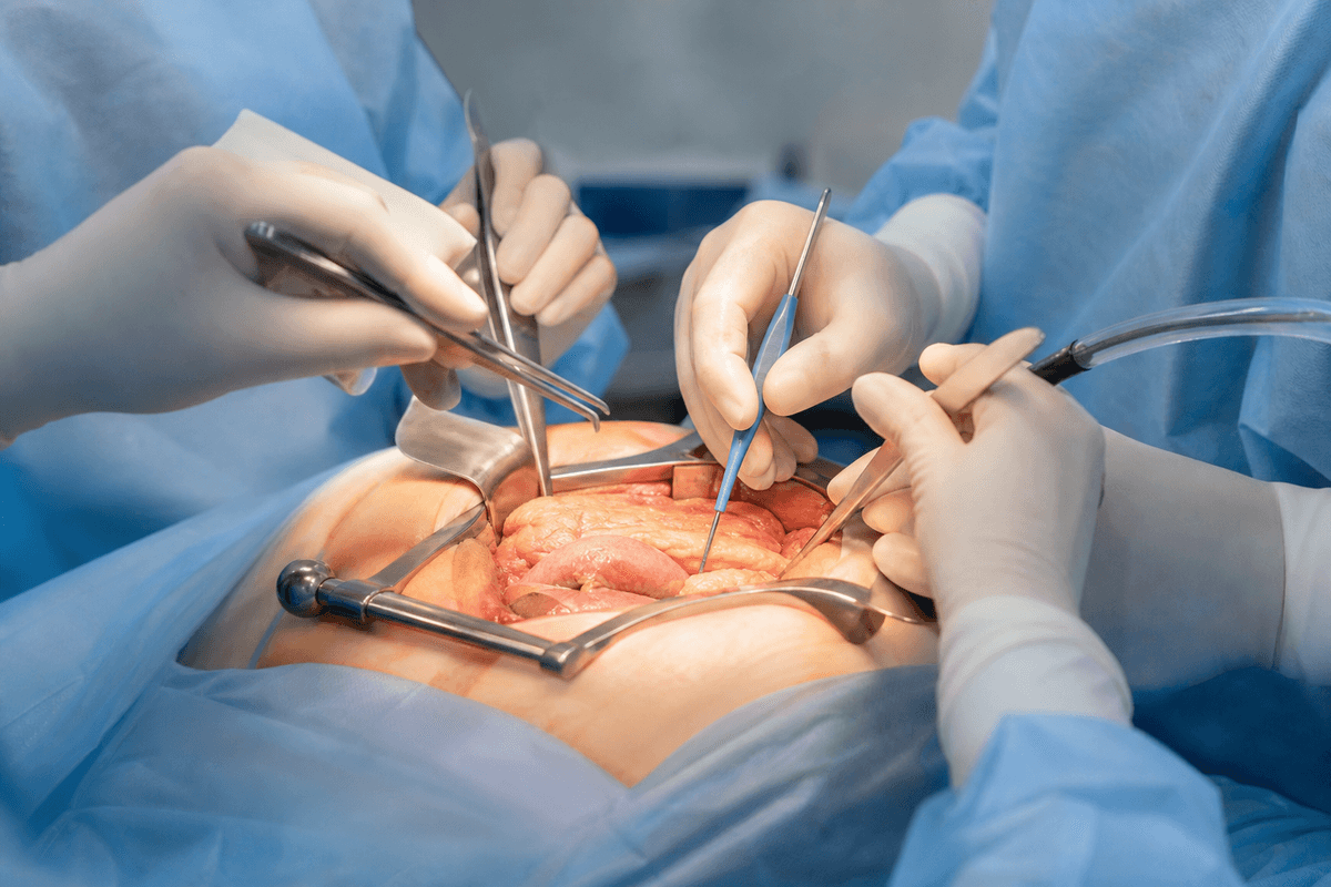 Pancreatic Surgery